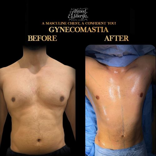 نحت الجسم بالفيزر للرجال في الرياض